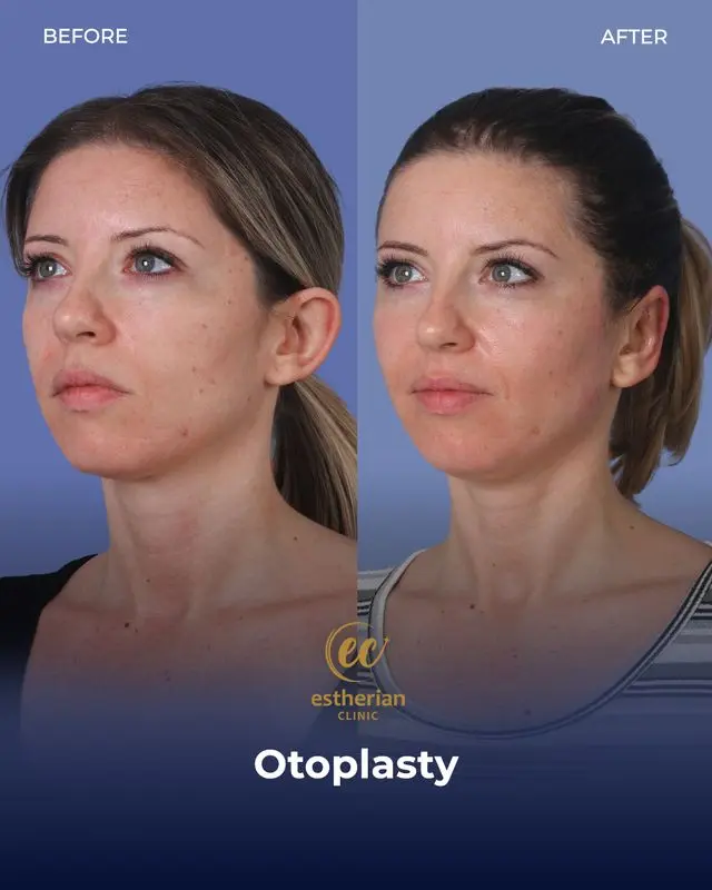 Otoplasty (before-and-after by the Estherian Clinic)