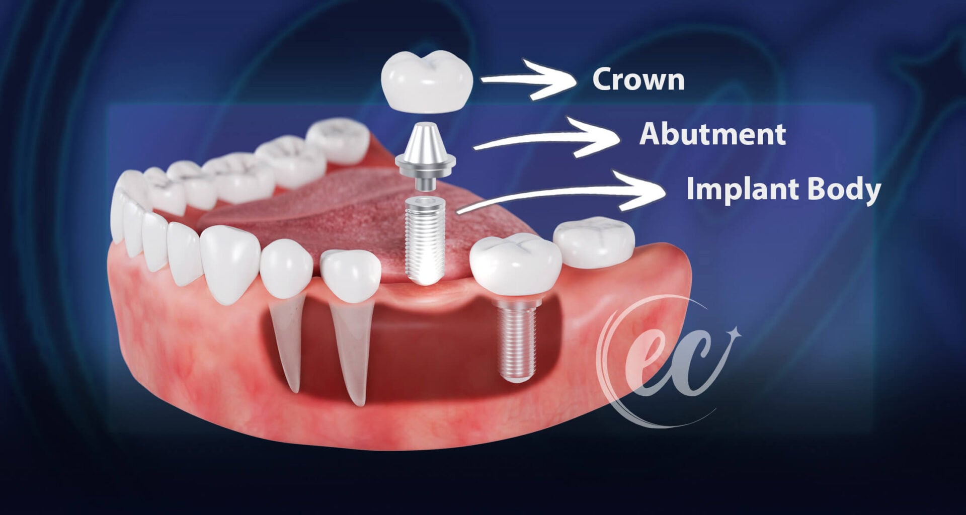 Parts of a Traditional Dental Implant (An Infographic by the Estherian Clinic)