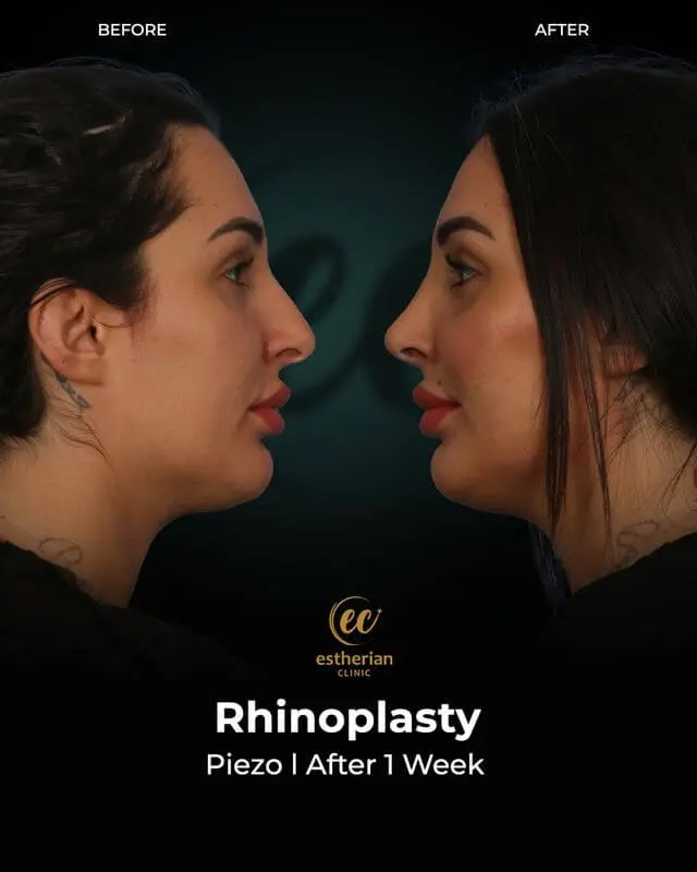 Plastic Surgery for the Face - Rhinoplasty Results by the Estherian Clinic