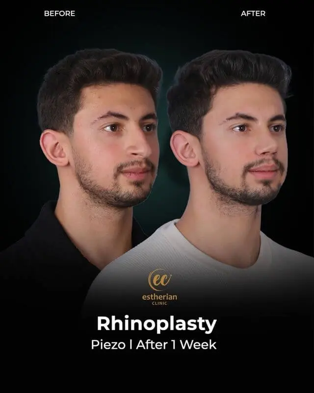Rhinoplasty for Men (Real Patient Surgery Results by the Estherian Clinic) Facial Plastic Surgery