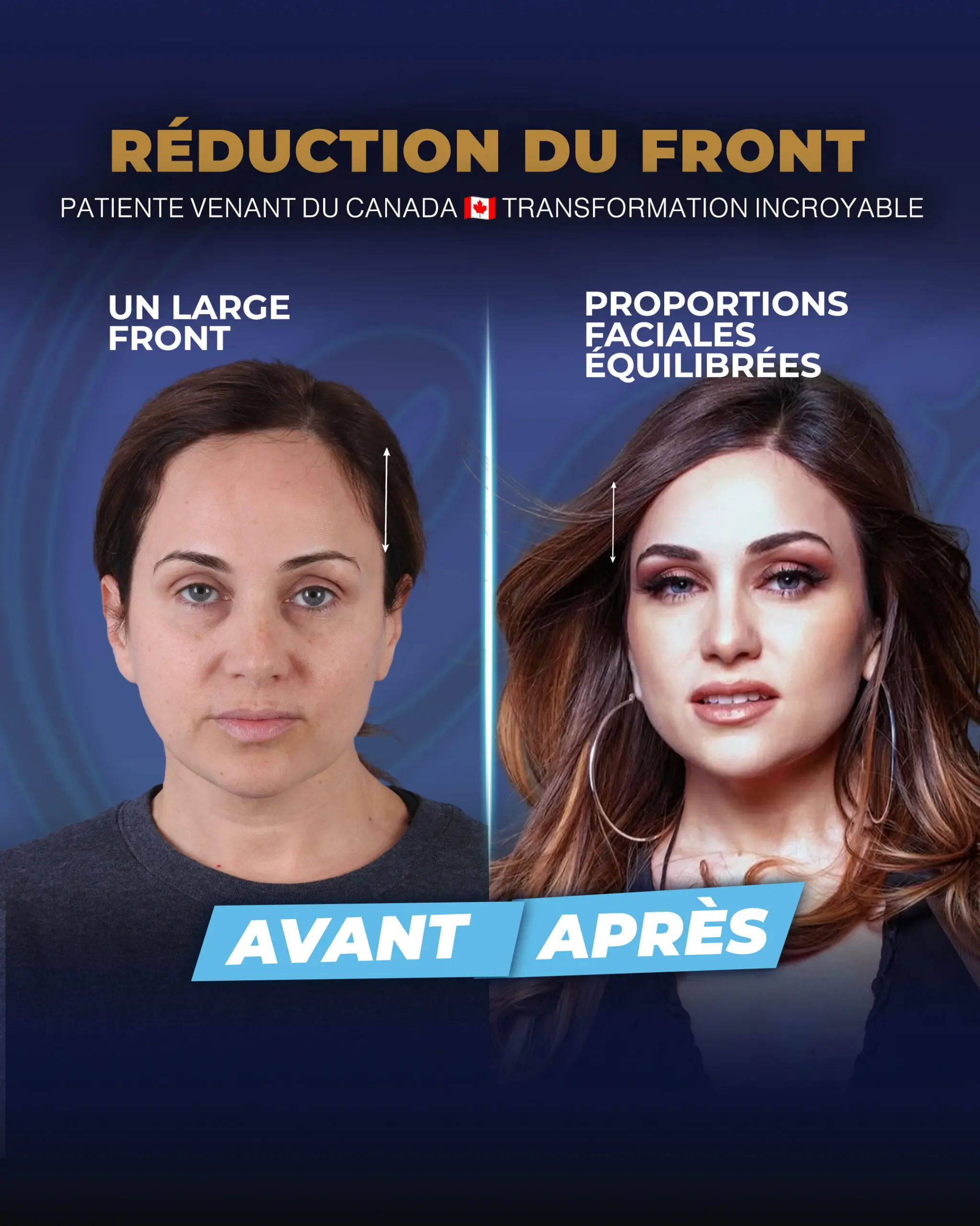 Transformation réelle d'une patiente après une réduction du front à la clinique Estherian