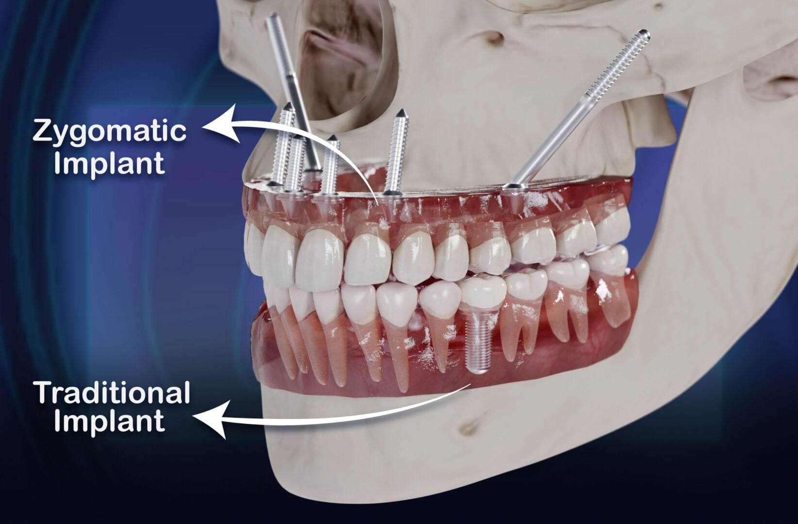 Inforaphic: Zygomatic Vs. Traditional Implant (Visual Guide) by the Estherian Clinic