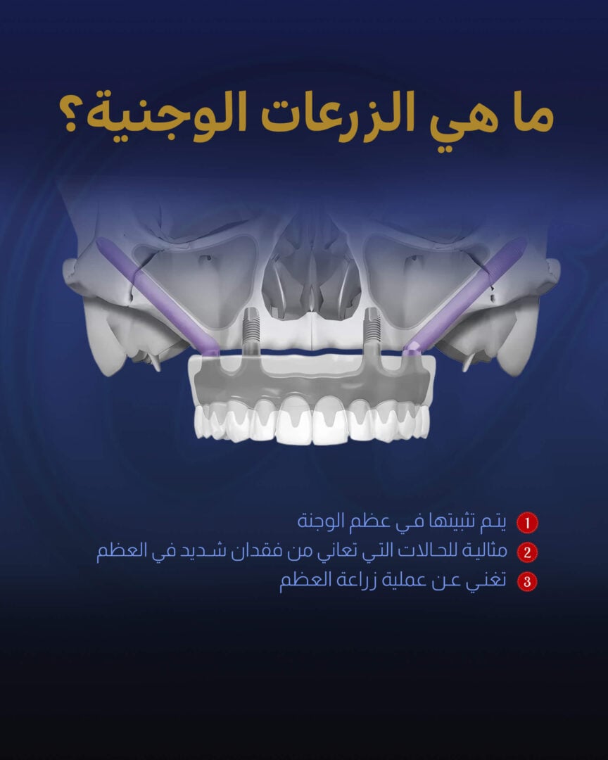 زراعة عظام الوجنة (دليل مرئي) من عيادة إستيريان