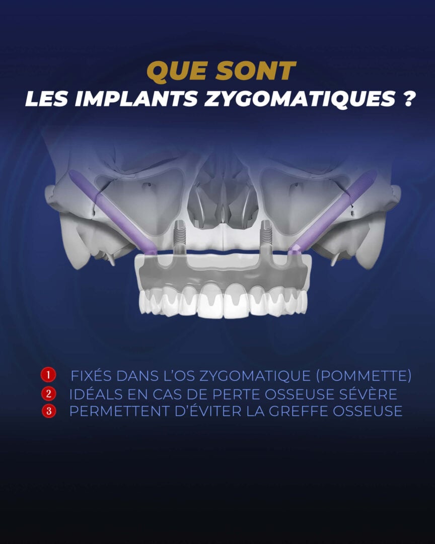 Implants zygomatiques (Guide visuel) par la clinique Estherian