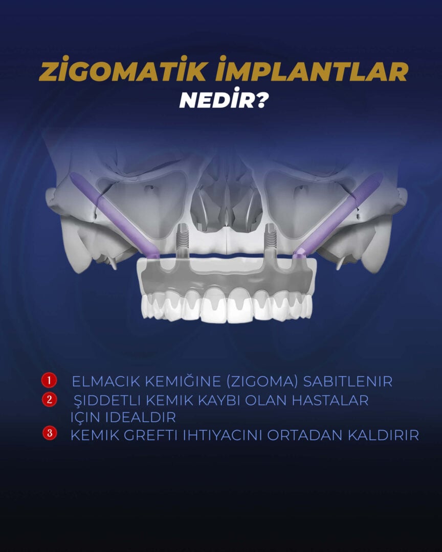 Elmacık Kemik İmplantları (Görsel Kılavuz) - Estherian Kliniği