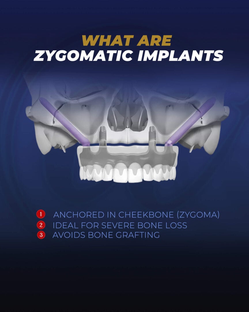 Inforaphgic: Zygomatic Implants ( A Visual Guide) by the Estherian Clinic