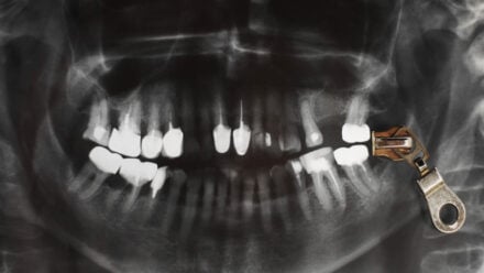 Zygomatic vs. Traditional Implants What’s the Real Difference