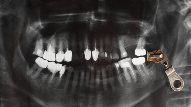 Zygomatic vs. Traditional Implants What’s the Real Difference