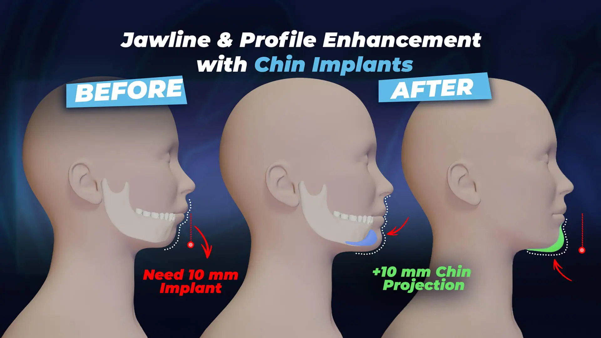 chin-implant-.jpg