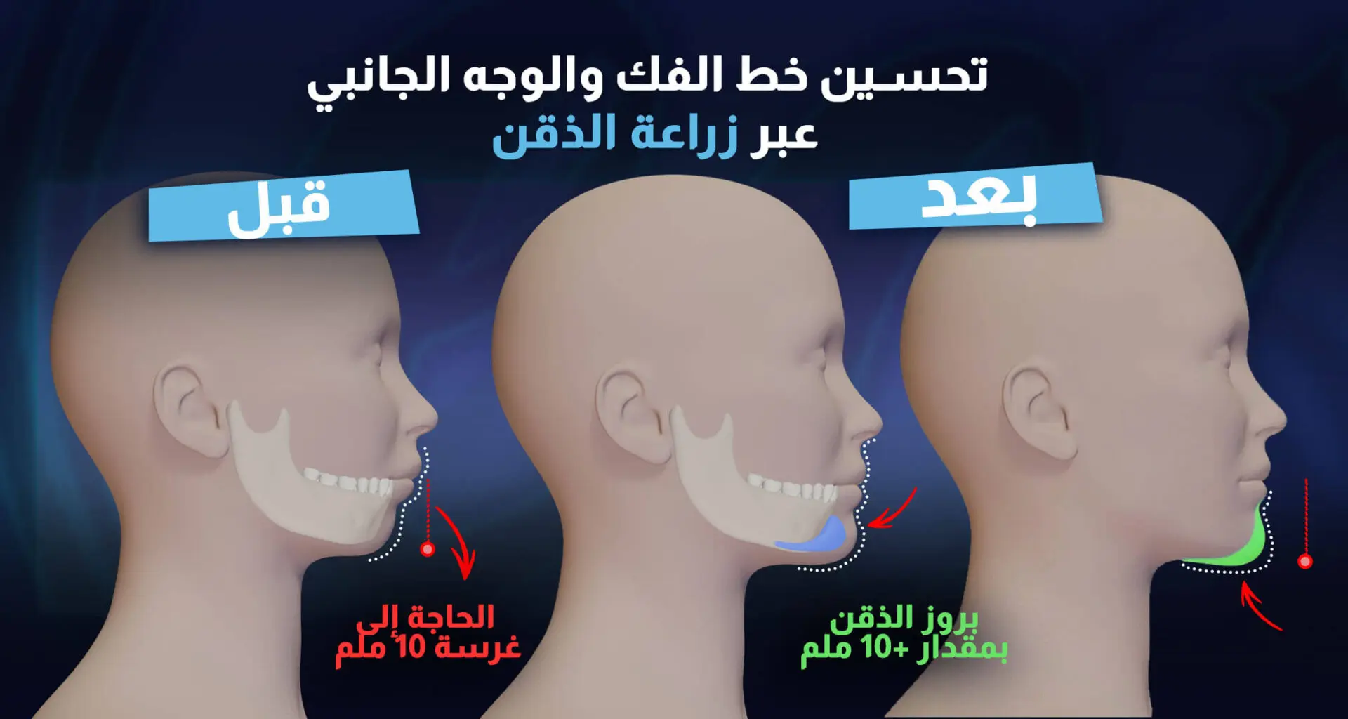 عملية زراعة الذقن في عيادة إستيريان