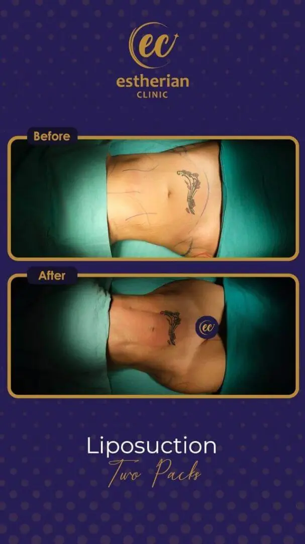 Karın Bölgesi Şekillendirme - Estherian Clinic'ten Kadınlar İçin İki Paket Liposuction