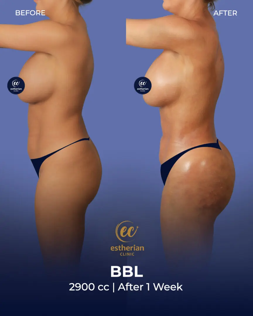 تحويل BBL