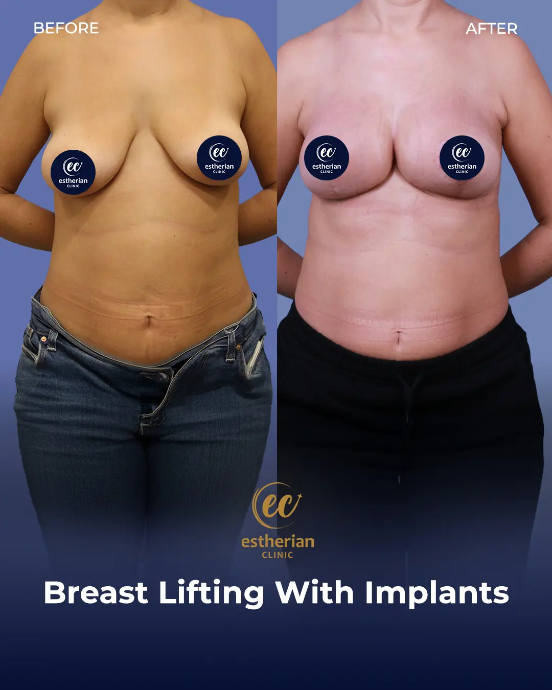BREAST LIFT-IMPLANT