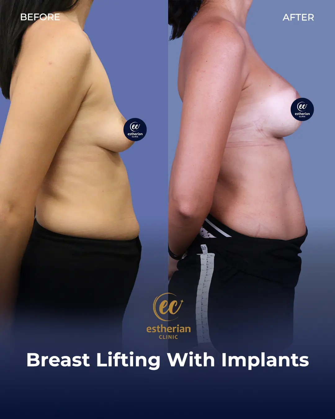BREAST LIFT-IMPLANT-N64