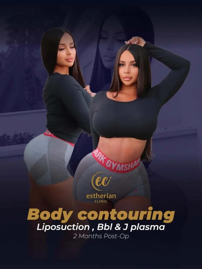 Vücut Şekillendirme - Liposuction, BBL ve J-plasma (Ameliyat Sonrası 2. Ay) Sonuçları, Estherian Kliniği