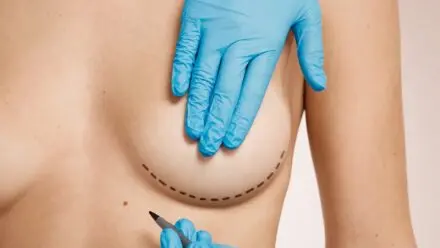 Breast Fat Transfer After 5 Years Exploring the Long-Term Results.jpg