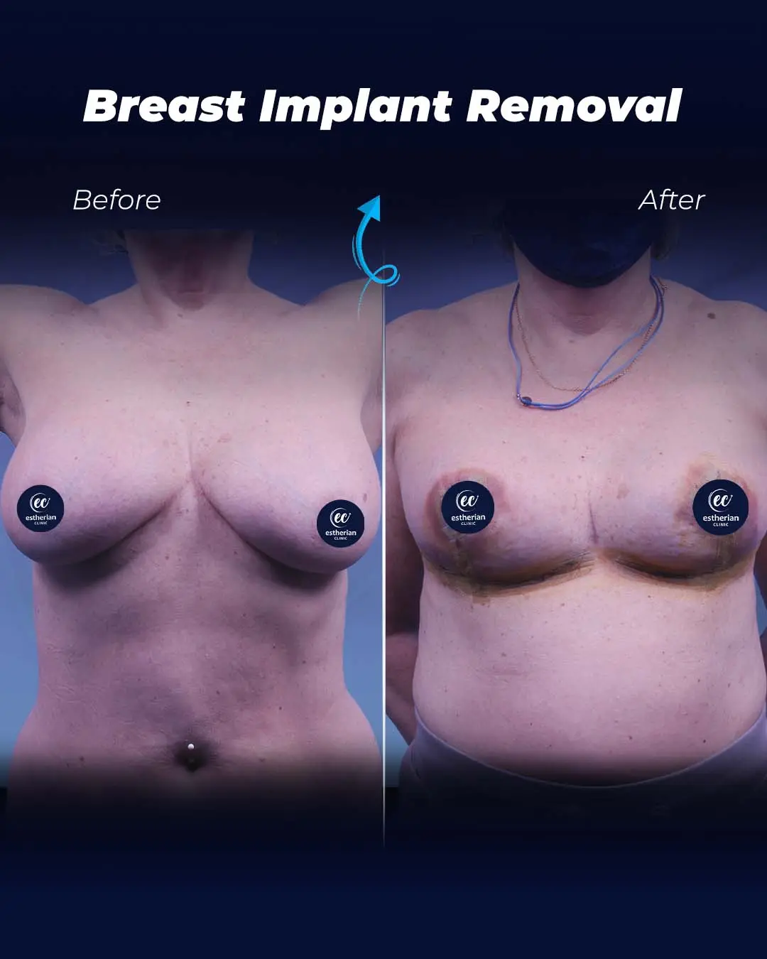 Breast-Implant-Removal-Before and after