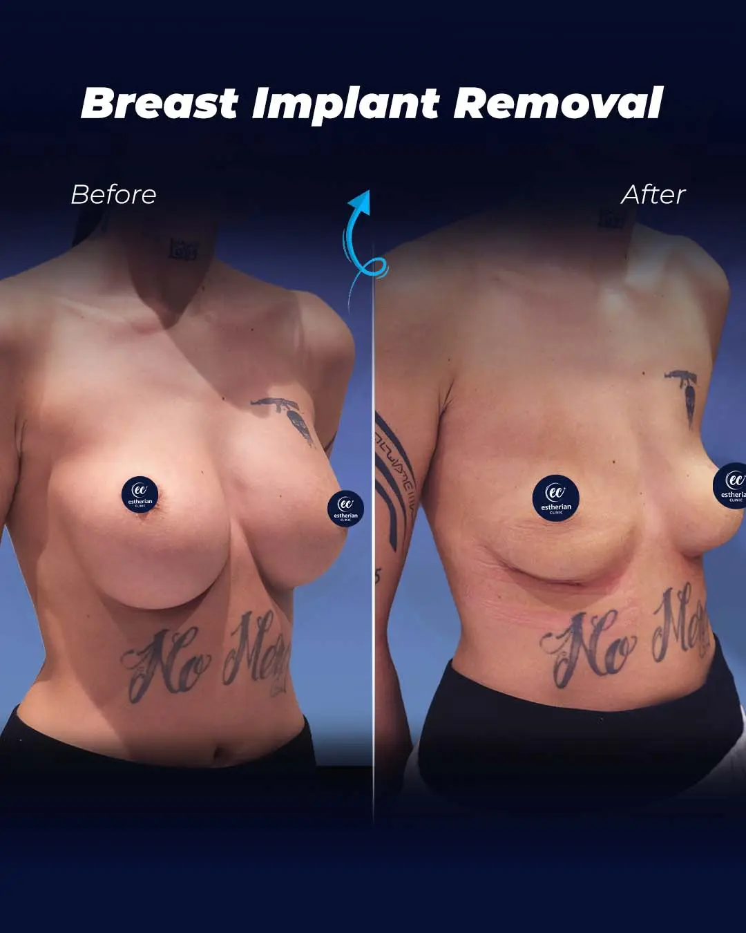 Breast-Implant-Removal-Real Patient Transformation