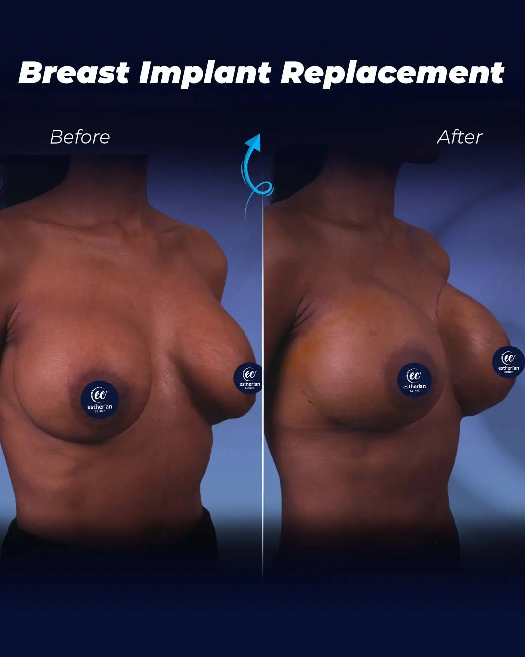 Breast Implant Replacement
