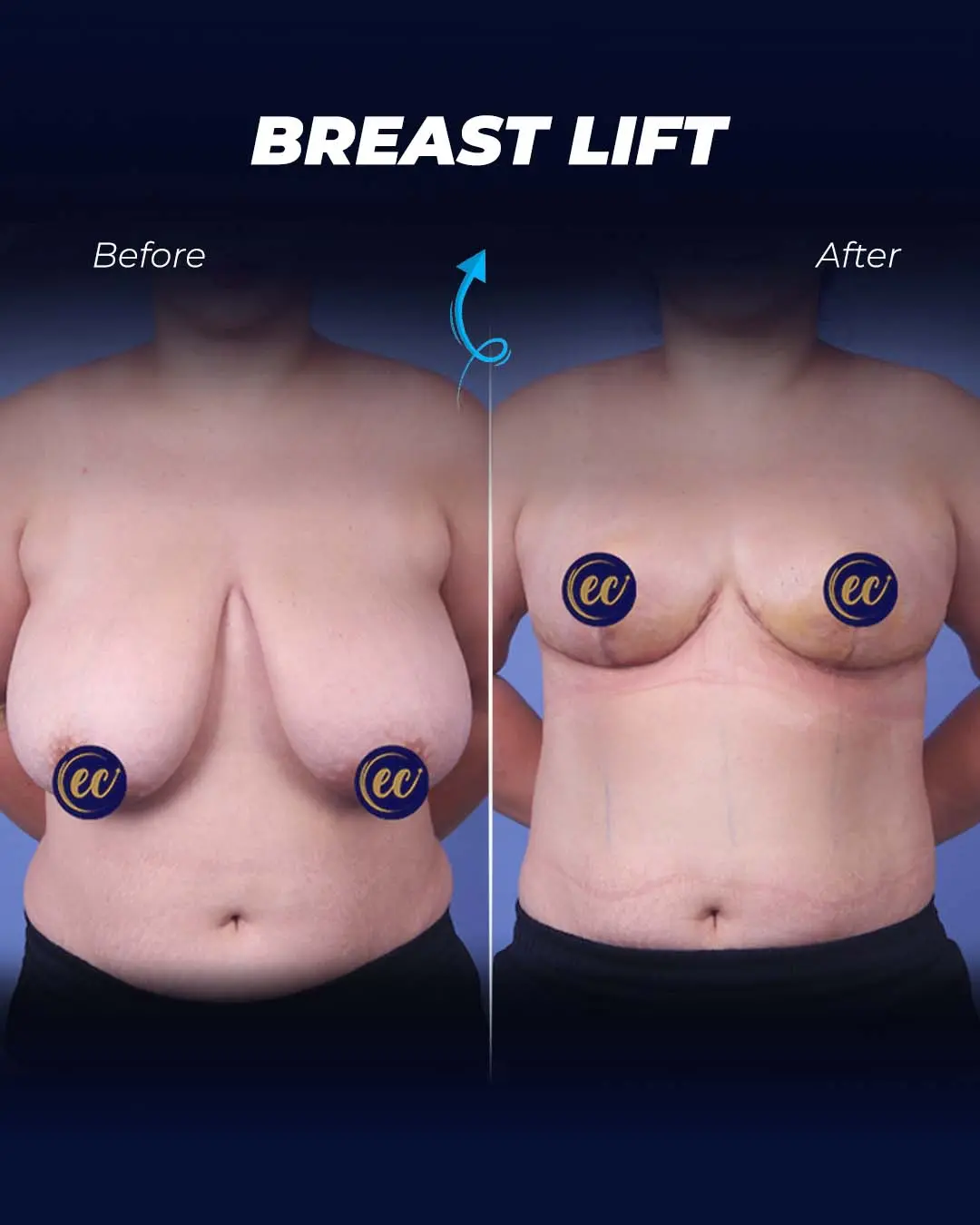 Breast-Lift Before and after