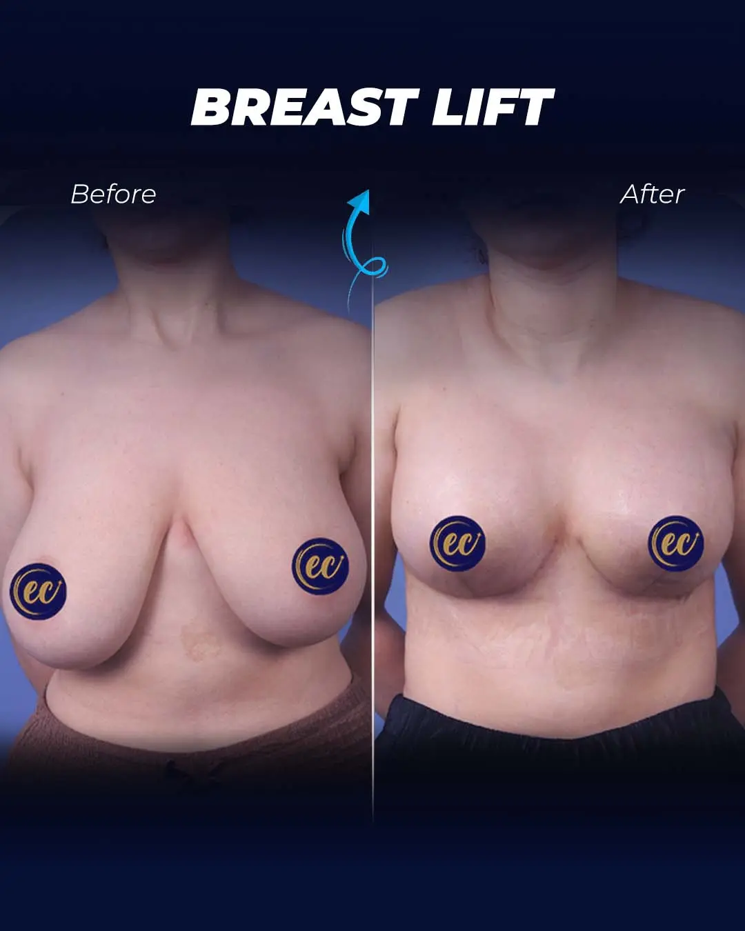 Breast-Lift Before and after