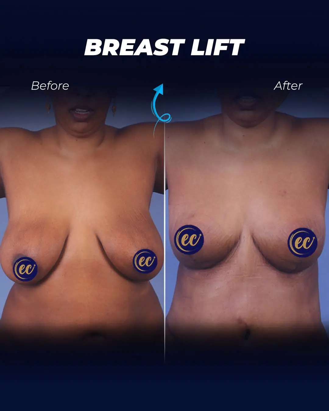 Breast-Lift Before and after
