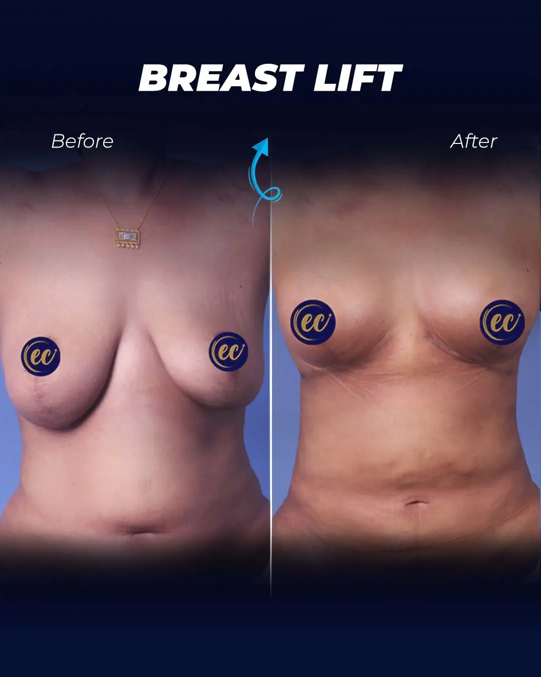 Breast-Lift Before and after