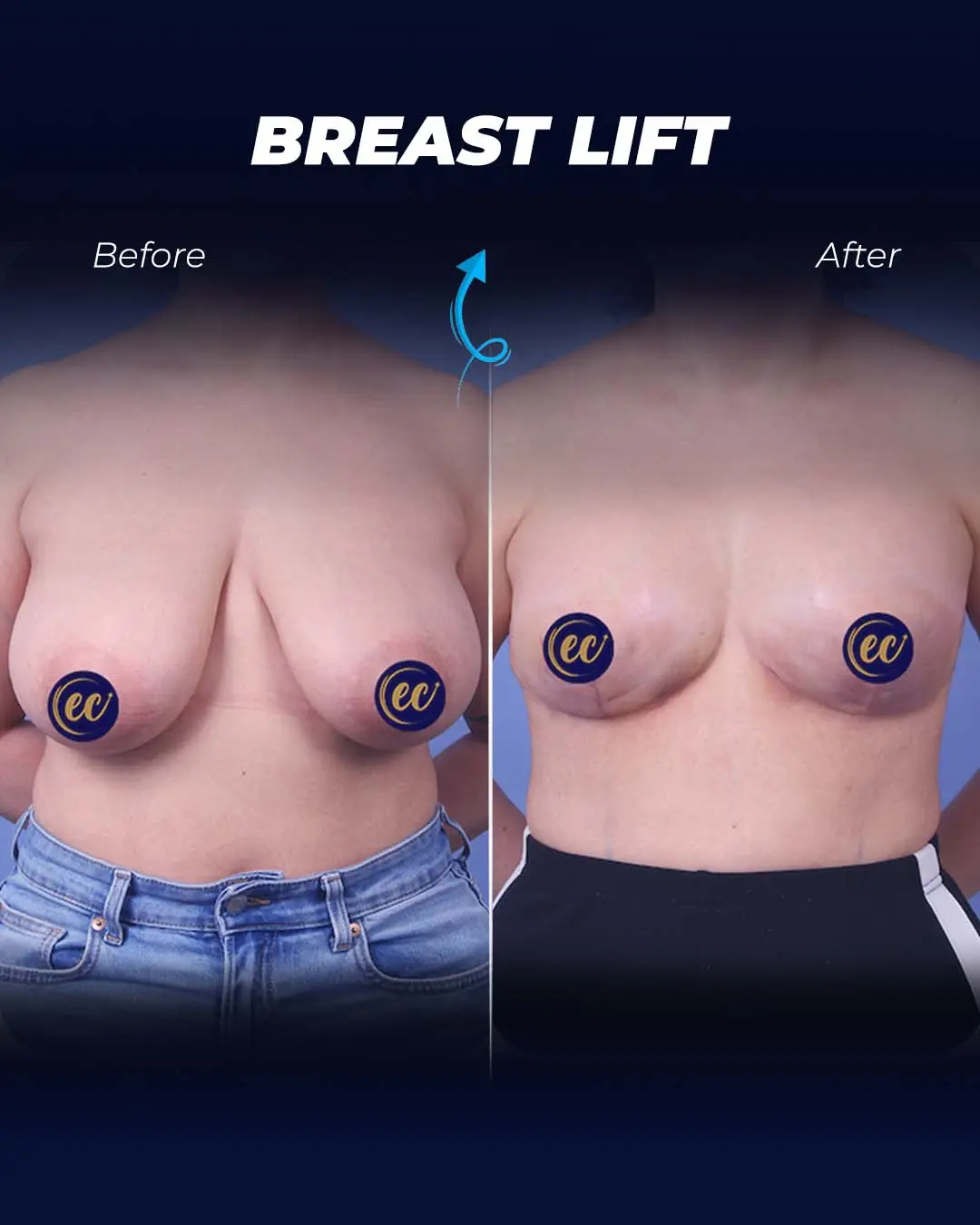 Breast-Lift Before and after