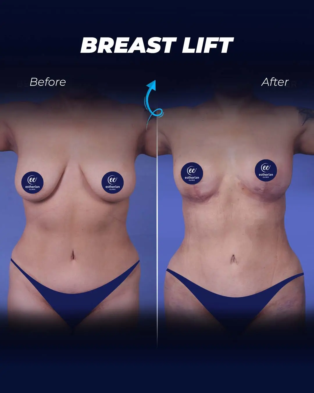 Breast-Lift Before and after