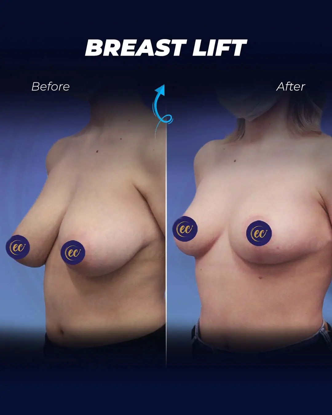 Breast-Lift Before and after