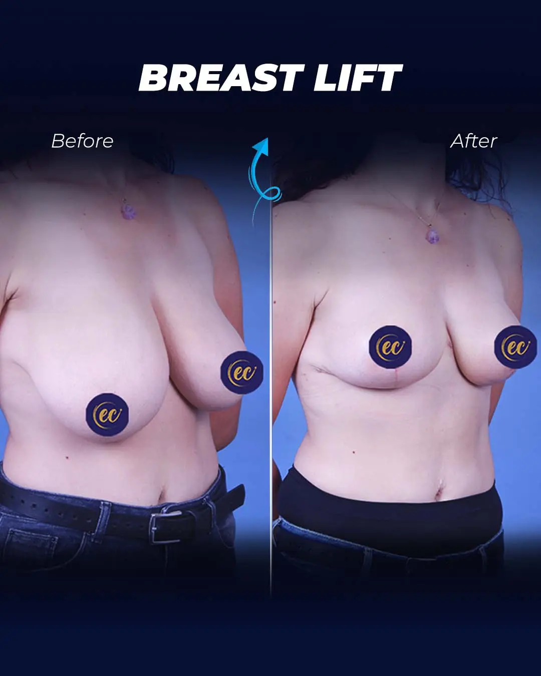 Breast-Lift Before and after
