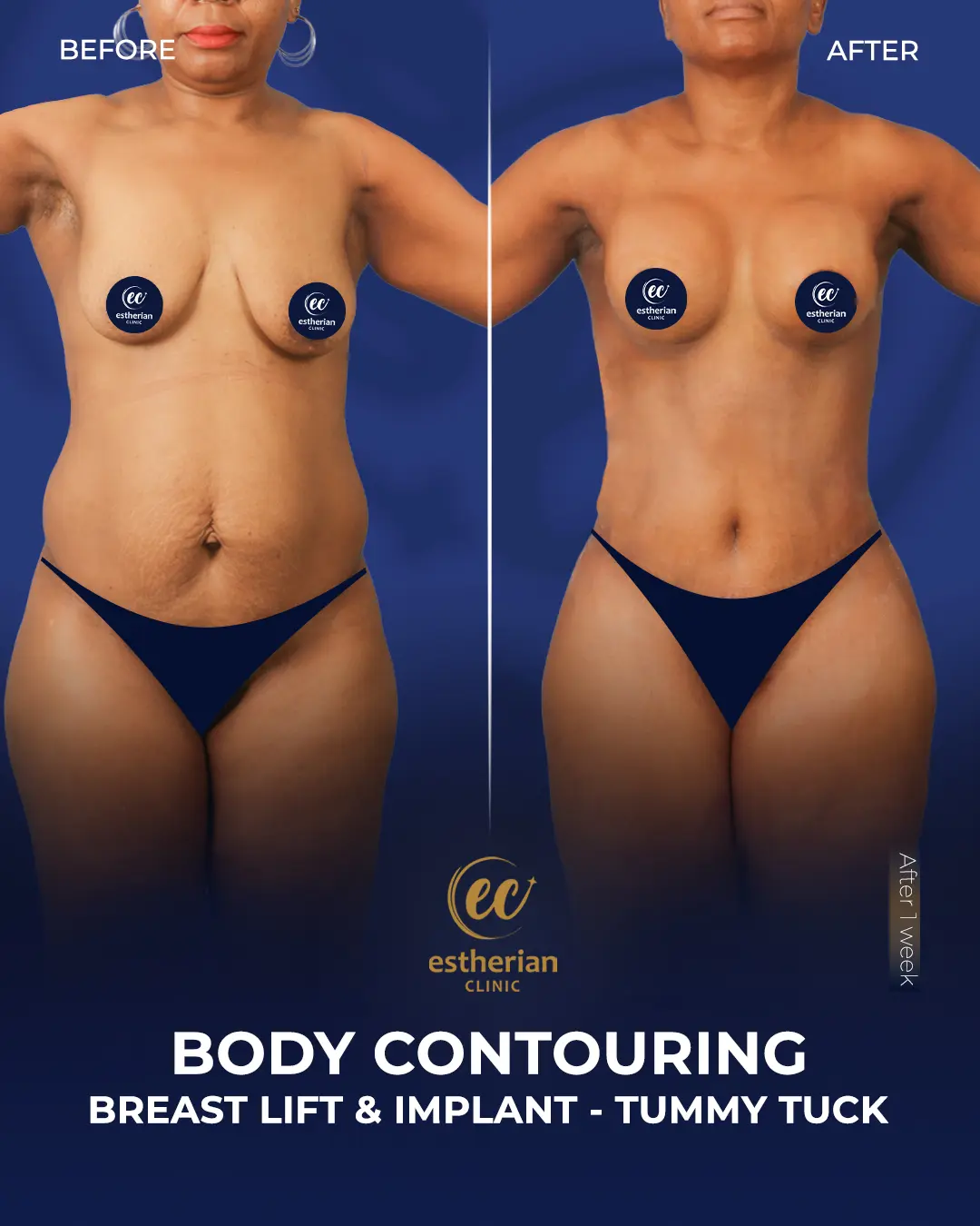Breast Lift - Implants - Tummy Tuck