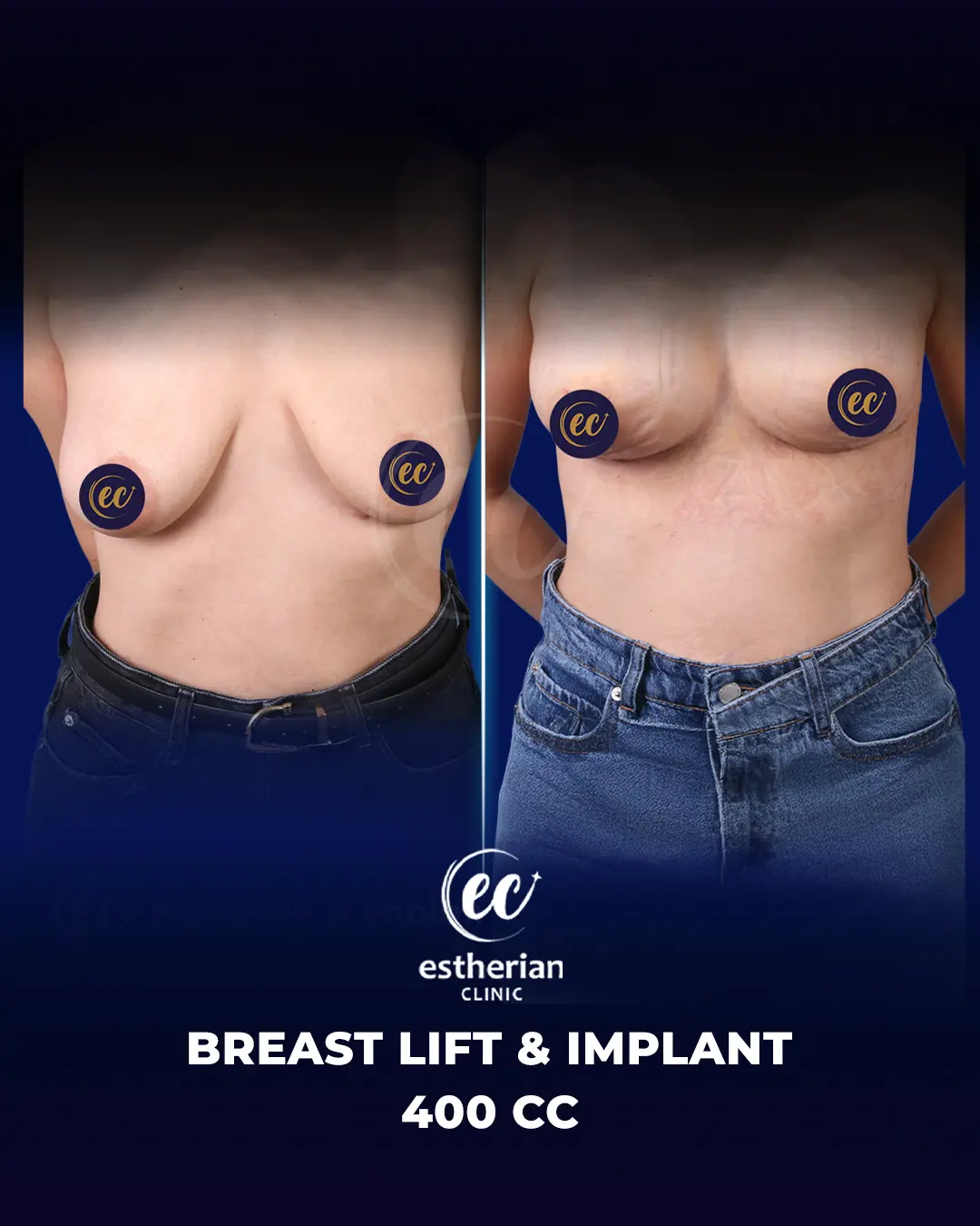 Breast Lift and 400cc Implants