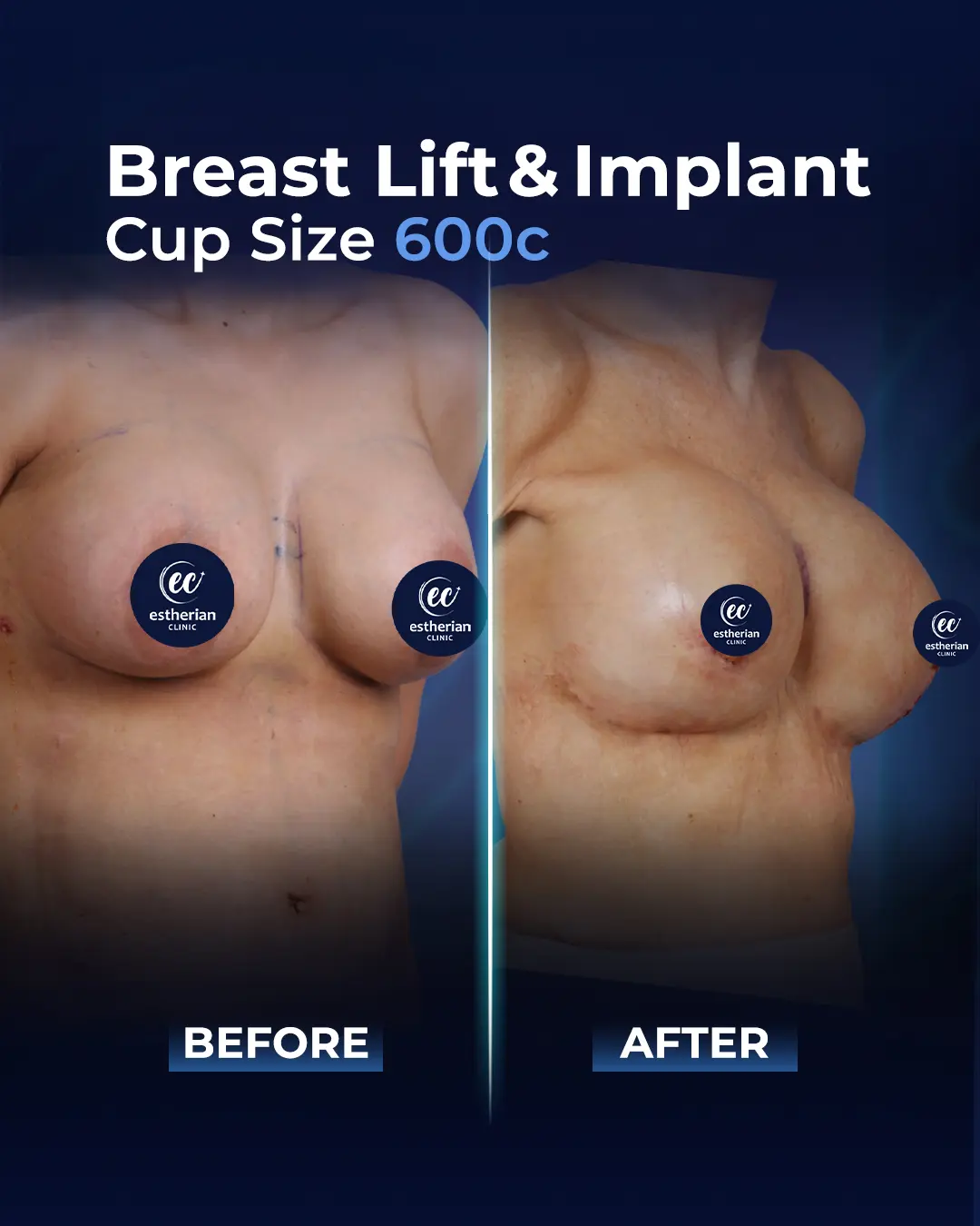 Breast Lift and 600cc Implants