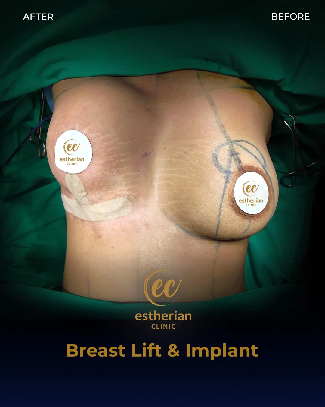 Breast Lift and Implant