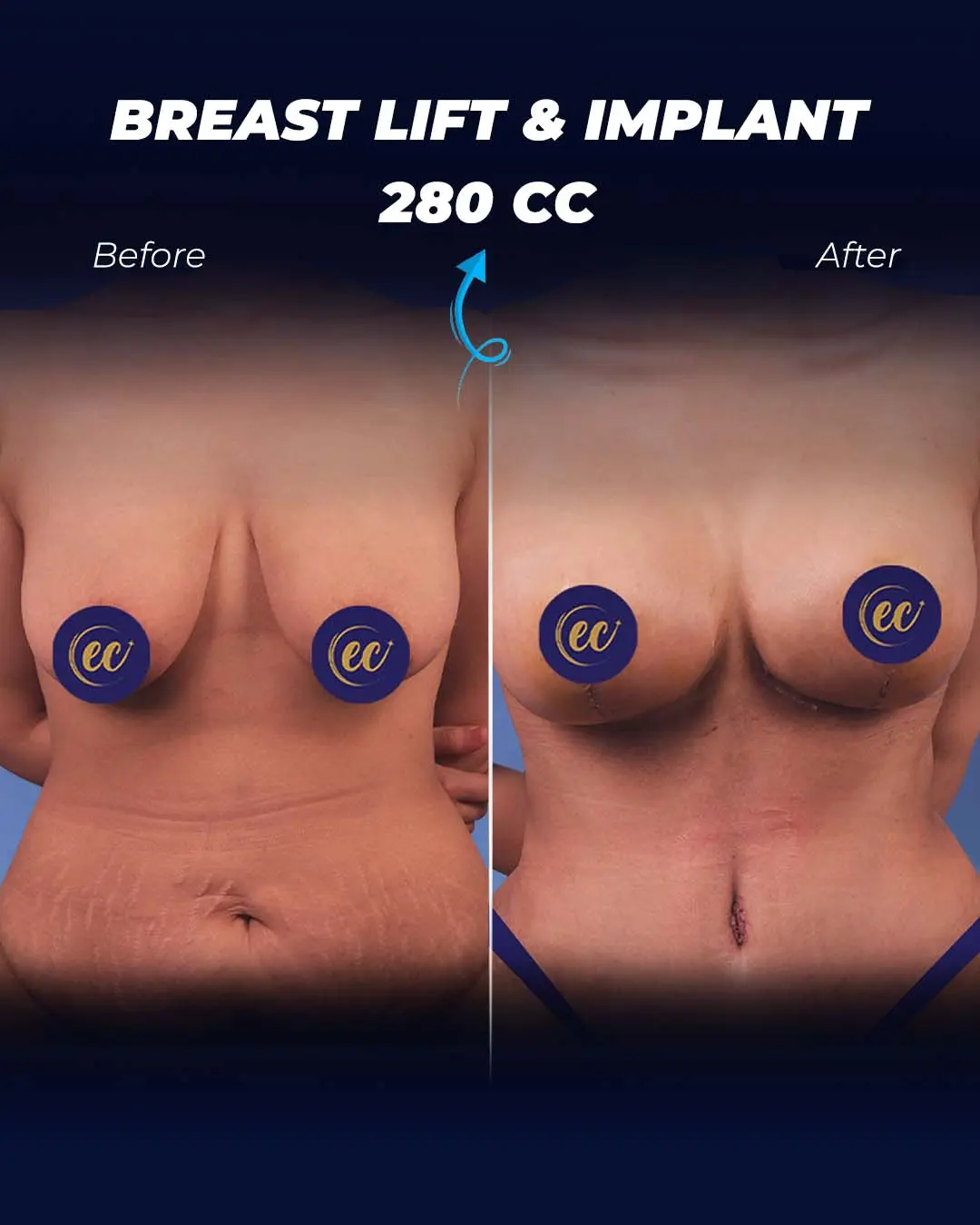 Breast-Lift-and-Implant-280CC-02