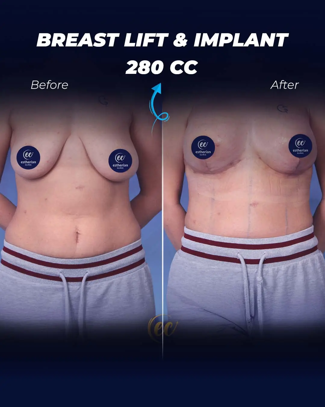 Breast-Lift-and-Implant-280cc
