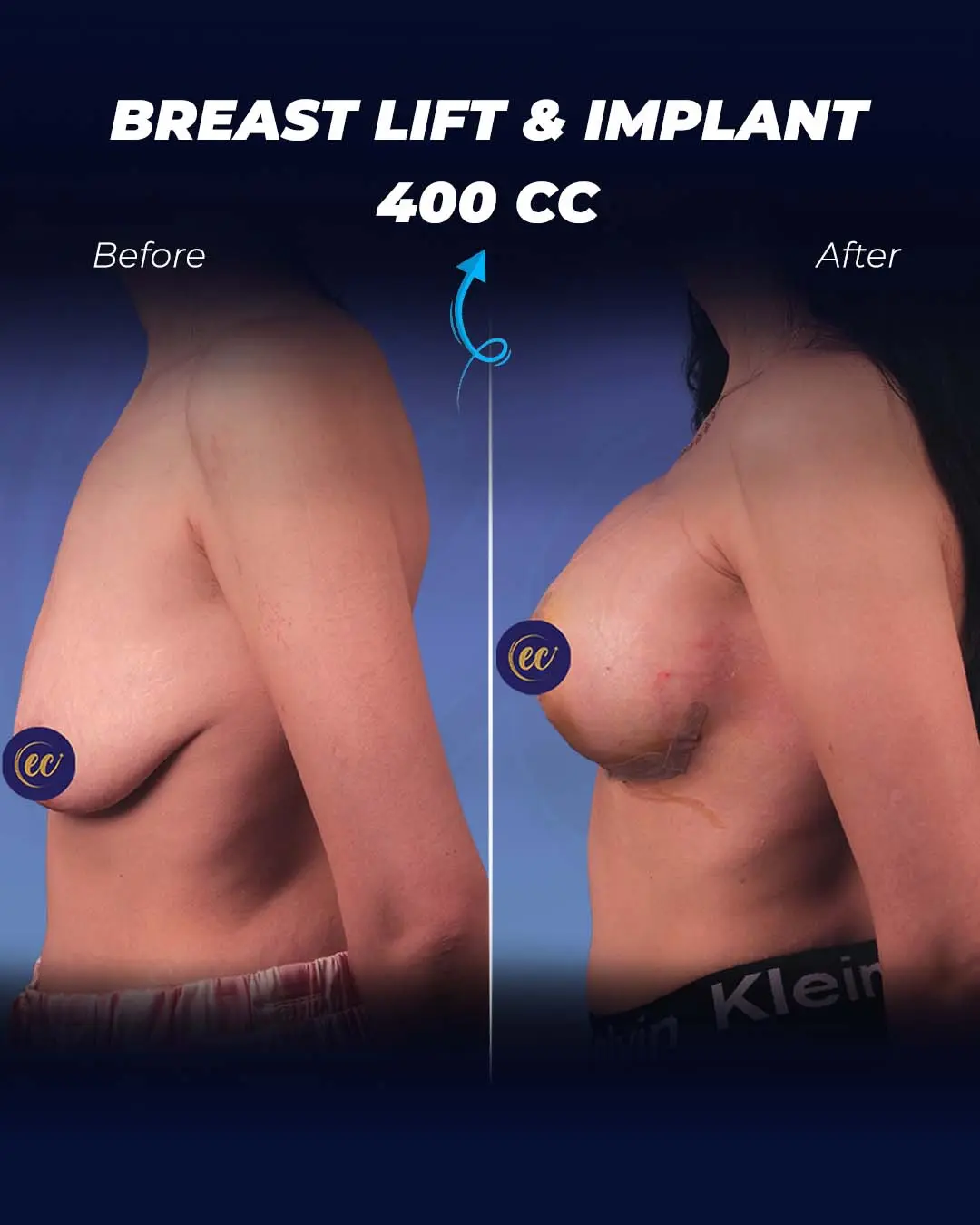 Breast-Lift-and-Implant-400CC-03