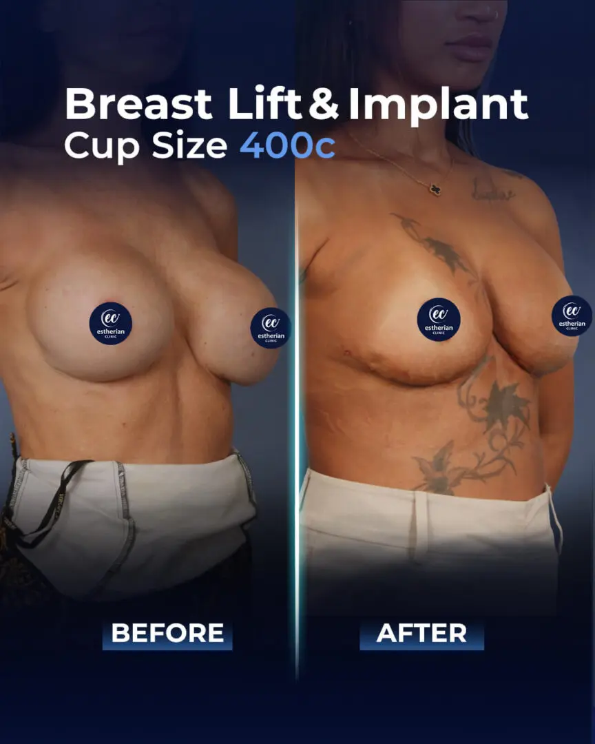 Bruststraffung und Implantat (400 ml) – Vorher-Nachher-Bilder der Estherian Klinik