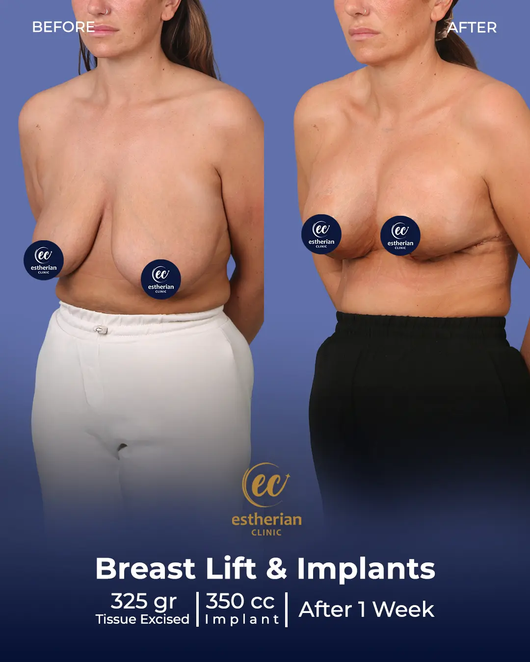 Breast Lift and Implants 350 cc.