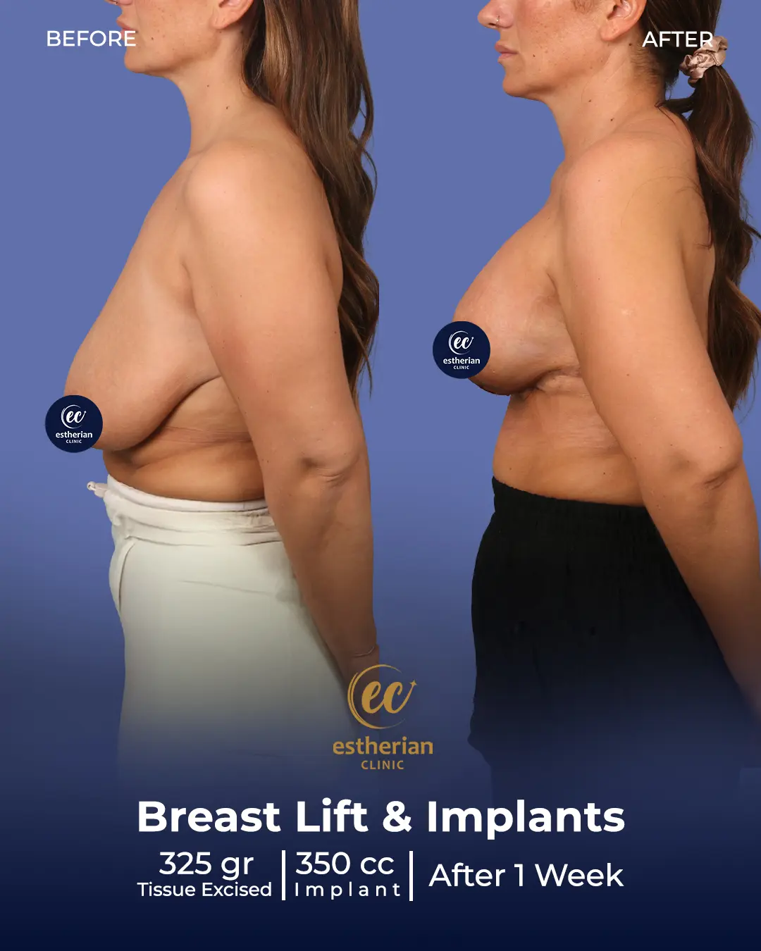 Breast Lift and Implants 350 cc