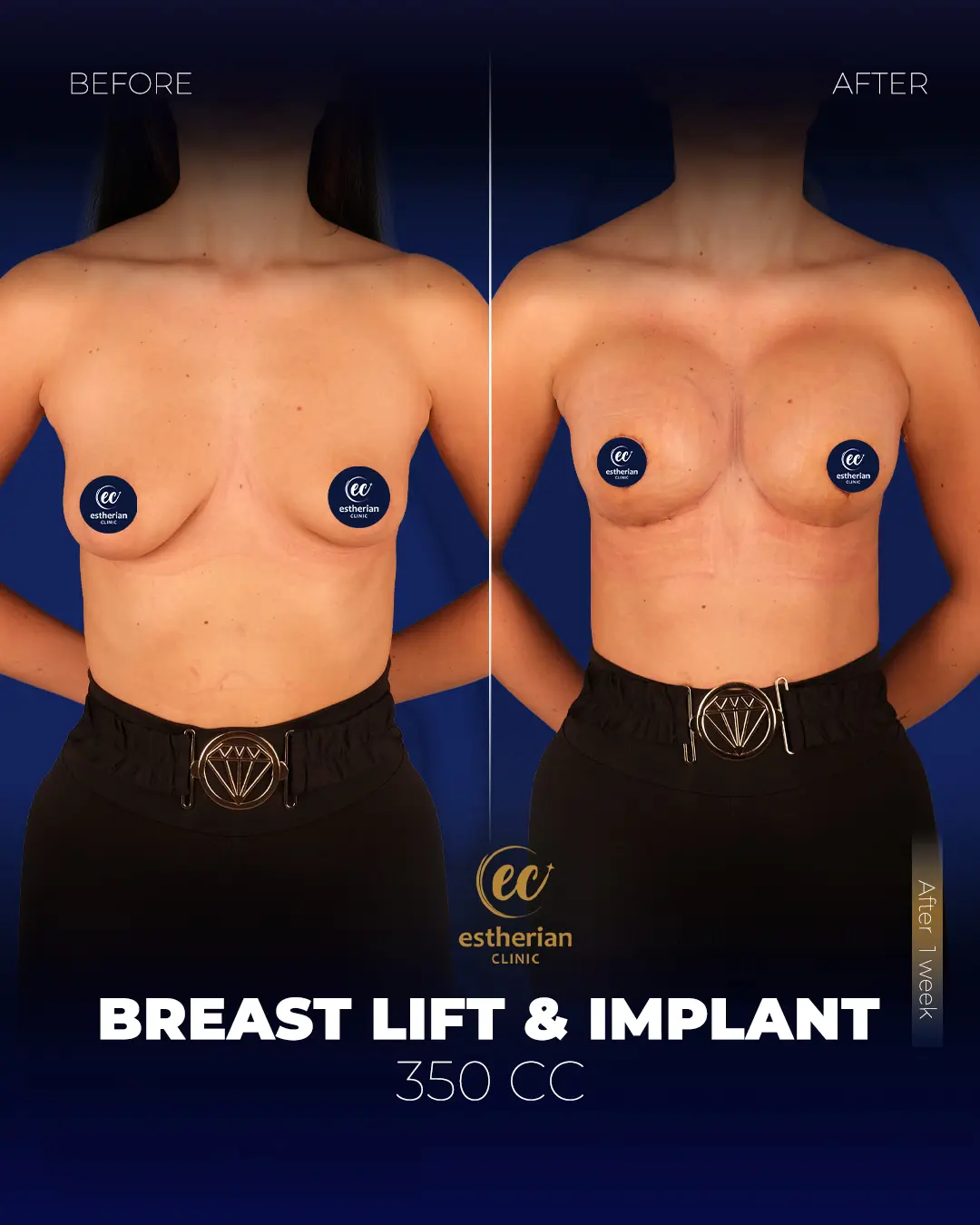 Breast Lift and Implants 350cc