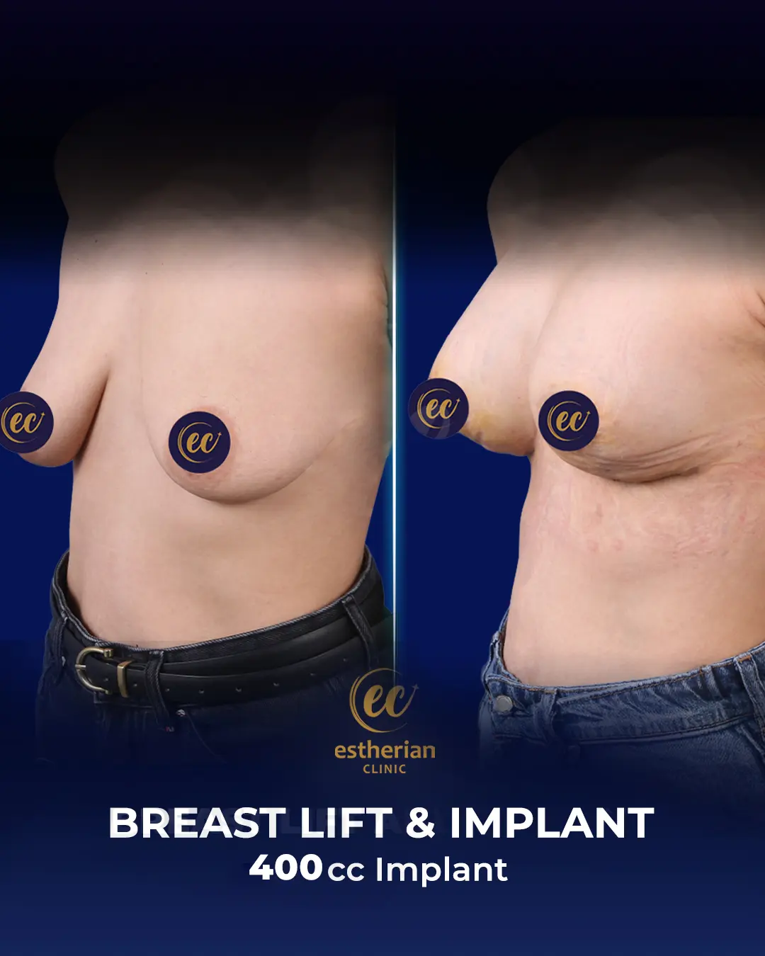 Breast Lift and Implants 400cc