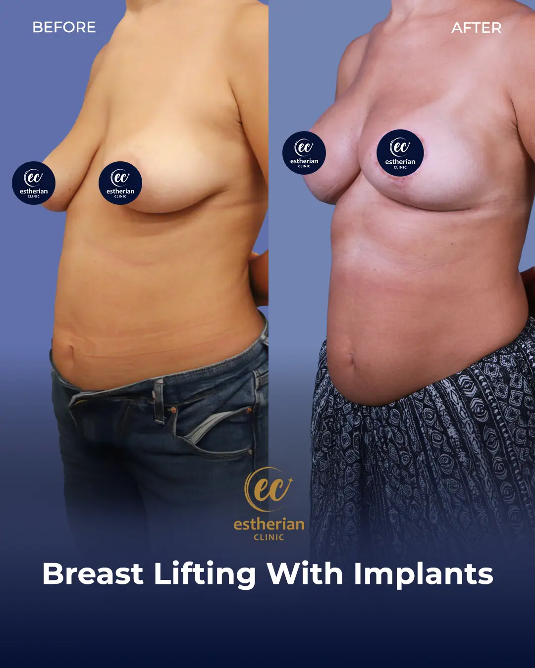 Breast Lifting and Reduction