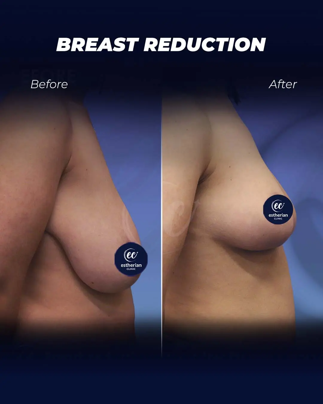 Breast Reduction- Before and After
