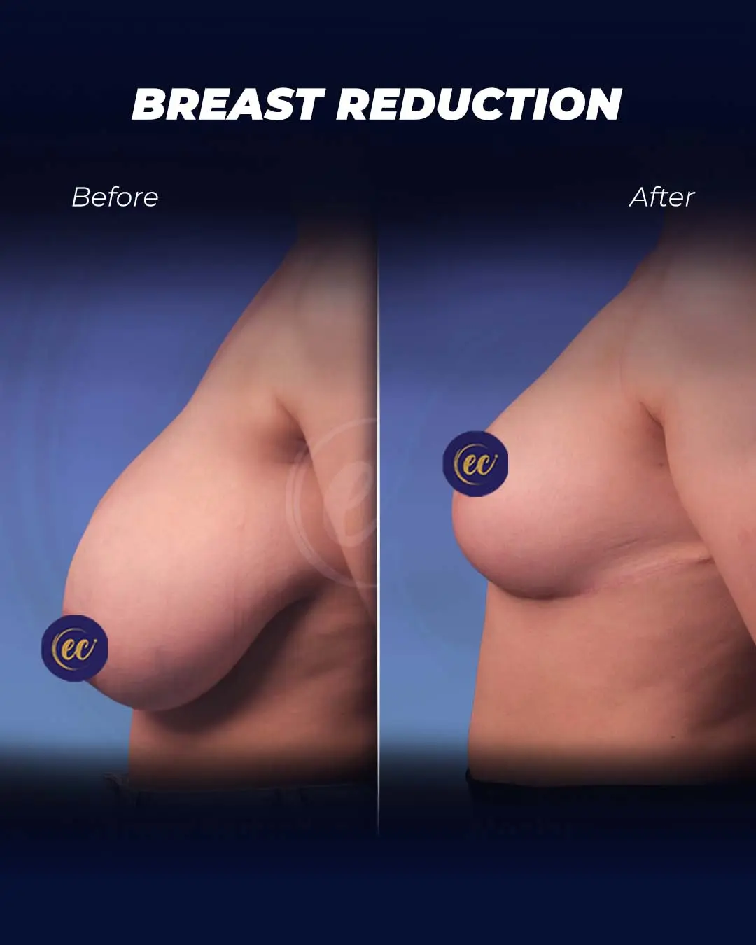 Breast Reduction-Before and after