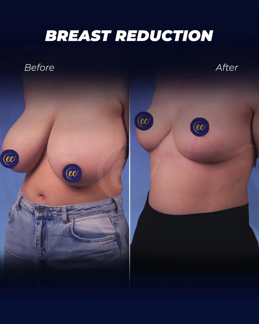 Breast Reduction-Real Patient Results