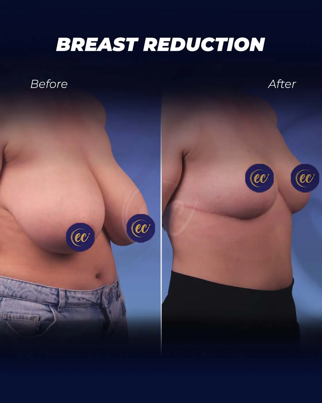Breast Reduction Real Transformation