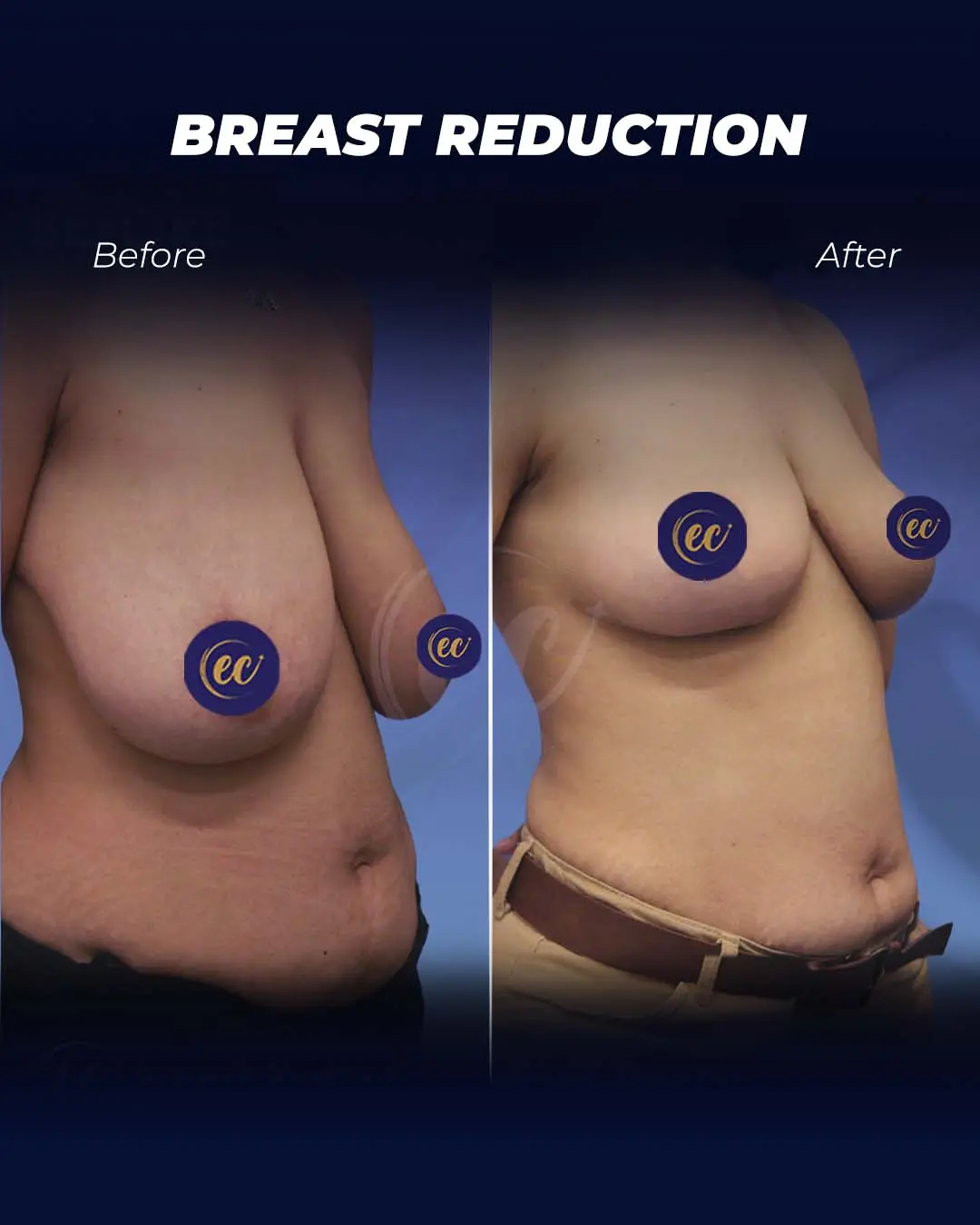 Breast Reduction-Results by the Estherian Clinic