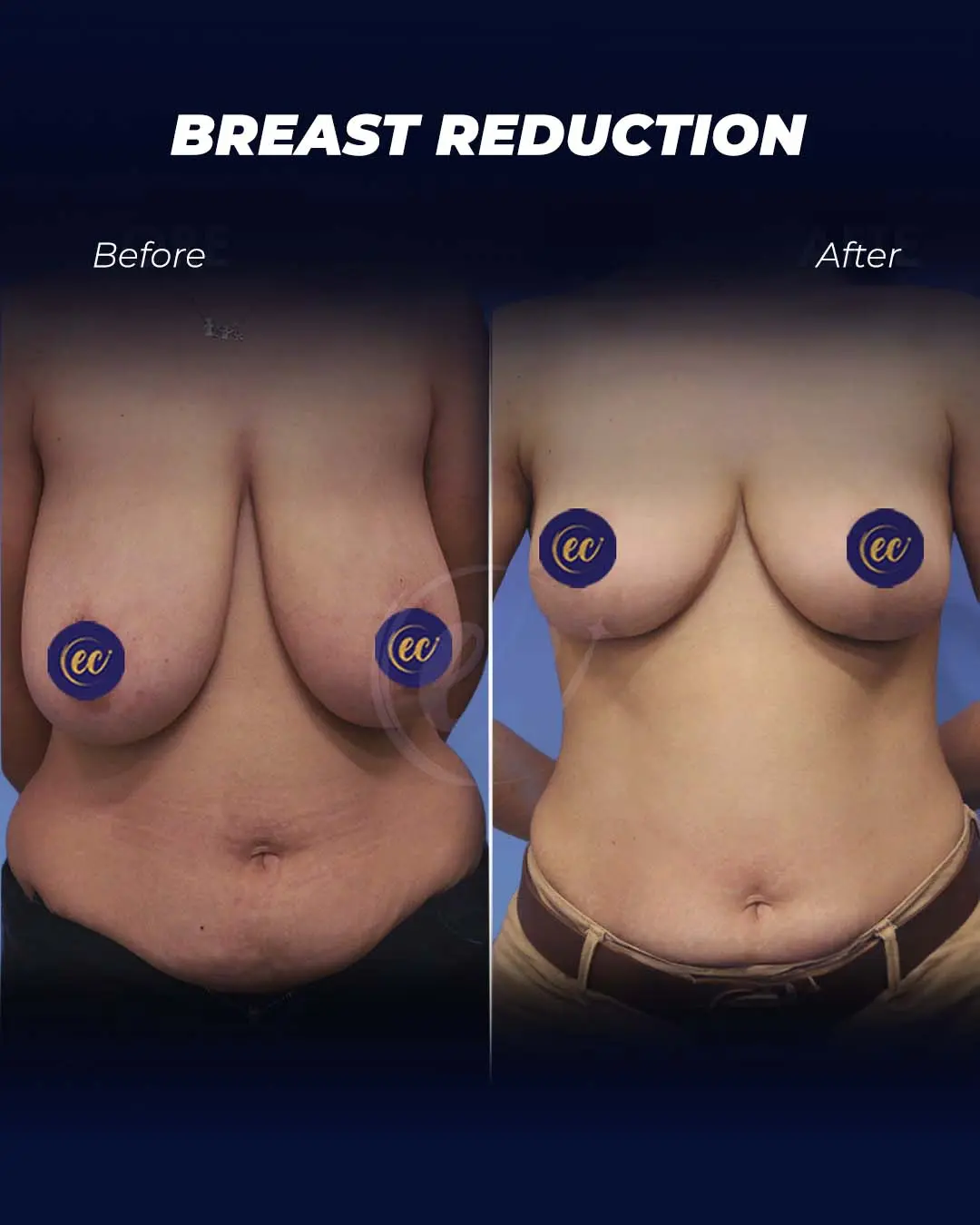 Breast Reduction-Transformation by the Estherian Clinic